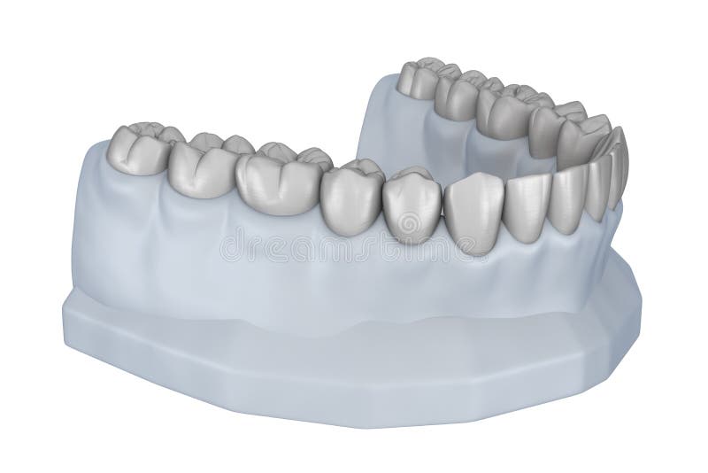 Waxup Teeth Model. Treatment Planning Stock Illustration
