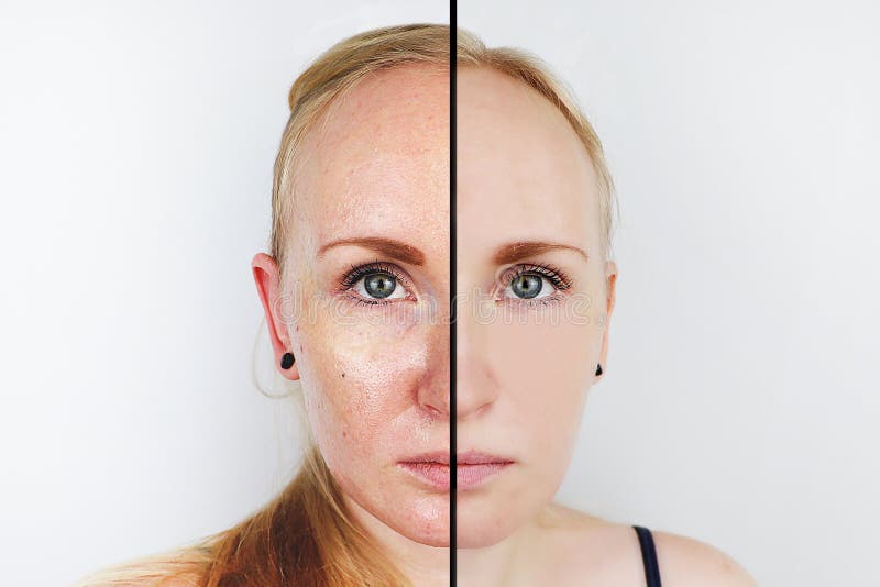 Wazeliniarska skóra i jasna skóra Dwa fotografii przed i po Portret dziewczyna z problemową skórą
