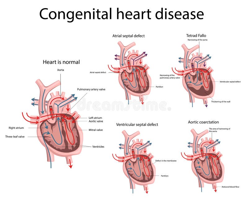 Congenital Disease Heart Stock Illustrations 191 Congenital Disease Heart Stock Illustrations Vectors Clipart Dreamstime