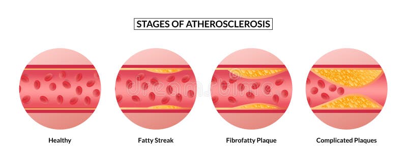 Stages of atherosclerosis. Atherosclerosis formation Healthy artery and unhealthy arteries. royalty free stock photos