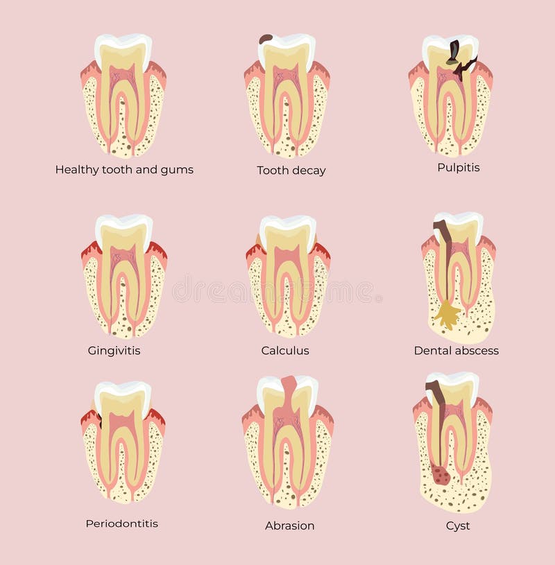 Abrasion Poster Stock Illustrations 80 Abrasion Poster Stock
