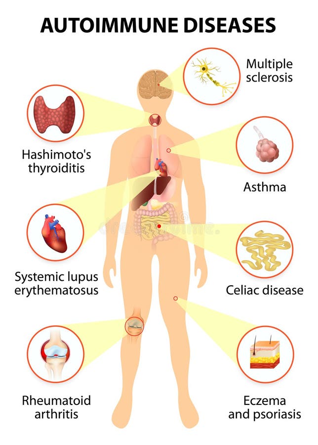 Weefsels van het menselijke die lichaam door auto-immune aanval wordt beïnvloed