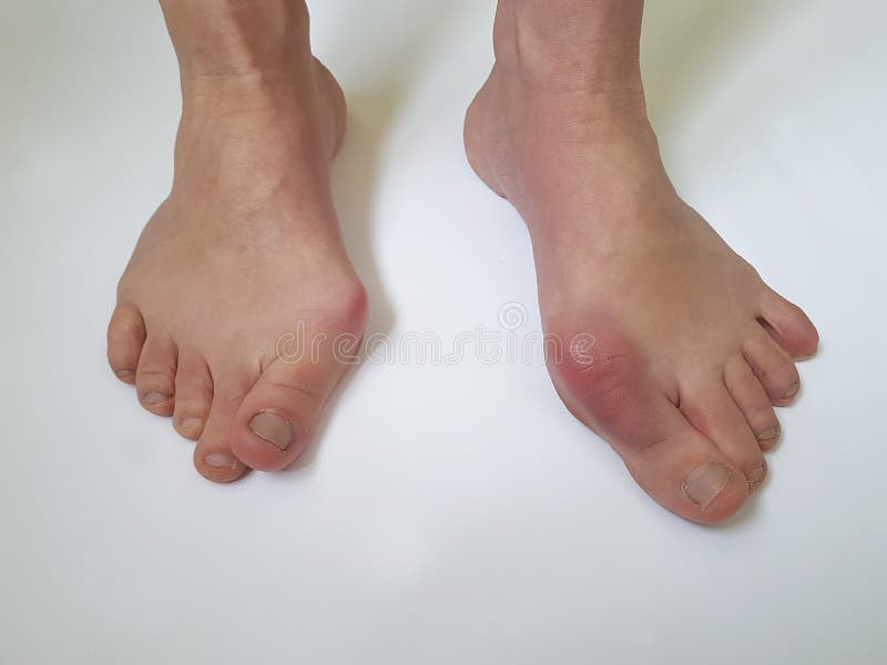 Weibliche Beinmissbildung des Hallux valgus schmerzlich auf einem weißen Hintergrund lizenzfreies stockbild Weibliche Beinmissbildung des Hallux valgus schmerzlich auf einem weißen Hintergrund lizenzfreies stockbild