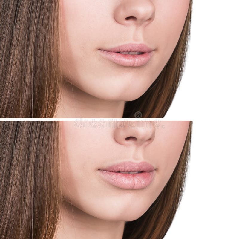 Weibliche Lippen vor und nach Vermehrung lizenzfreies stockbild Weibliche Lippen vor und nach Vermehrung lizenzfreies stockbild