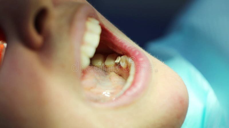 Weibliches Maul mit Implantat während der Zahnbehandlung stock video footage