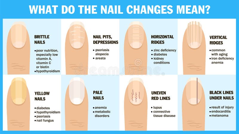 Brittle Nails: How to Treat Them and Why They Happen