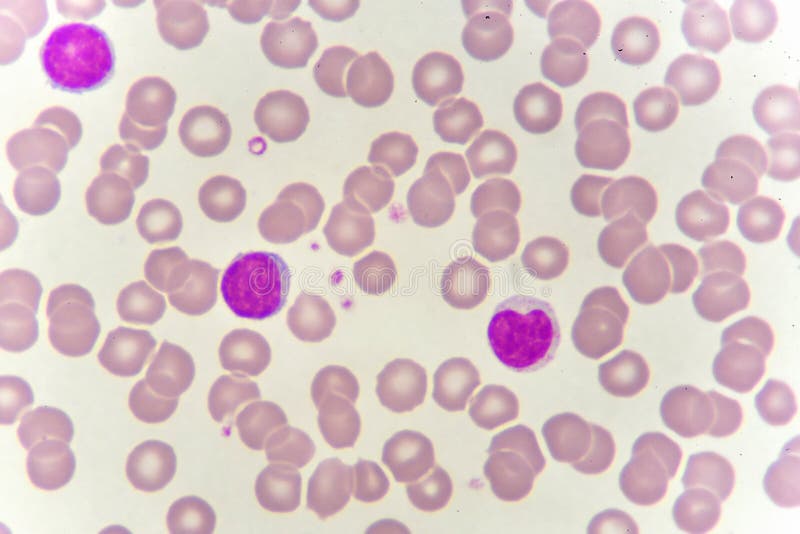 White Cells in Blood Smear Image - Image of monocyte,