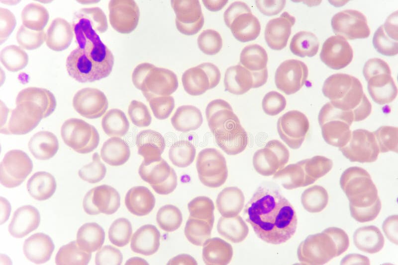 Larry Belmont Filthy Recognition White Blood Cells in Blood Smear Stock Photo - Image of health, laboratory:  123754710