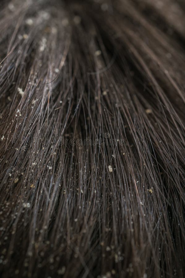 Dandruff Flakes Stock Photos Download 30 Royalty Free Photos