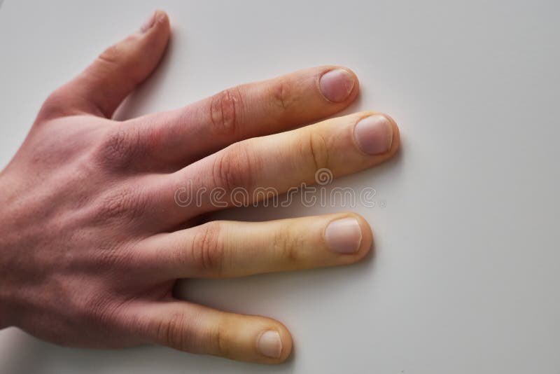 White fingers from the cold, poor blood circulation,close up. White fingers from the cold, poor blood circulation royalty free stock images
