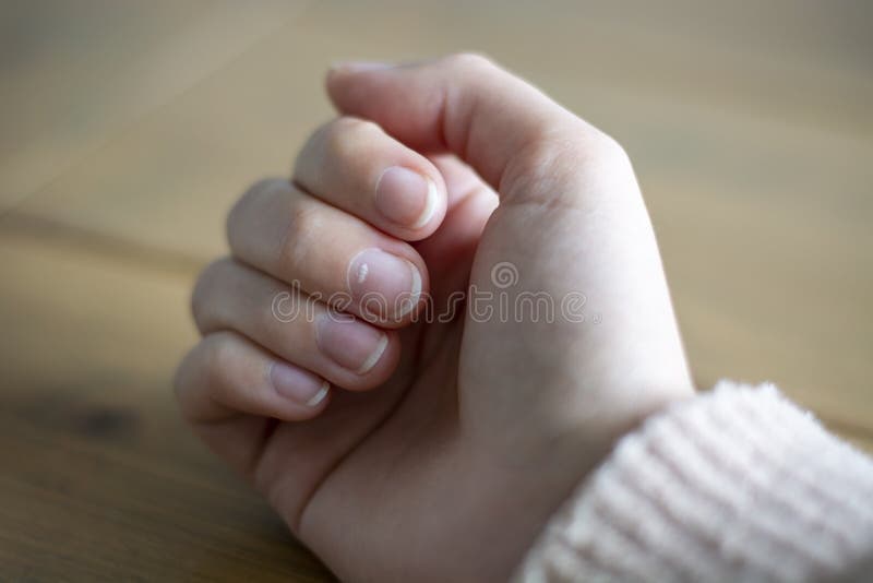 228 White Spots Nails Stock Photos - Free & Royalty-Free Stock Photos from Dreamstime 228 White Spots Nails Stock Photos - Free & Royalty-Free Stock Photos from Dreamstime