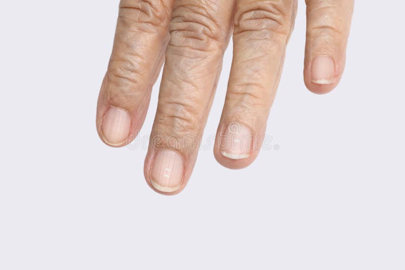 White Spots Nails Male Hand Caused Deficiency Calcium Zinc Poisoning Stock  Photo by ©AxOst 353643498