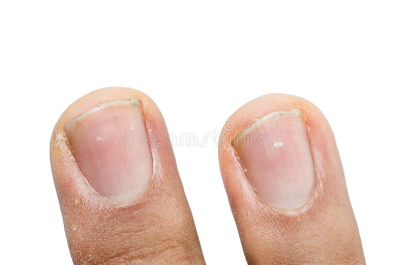 How To Remove White Spots From Fingernails? - Boldsky.com