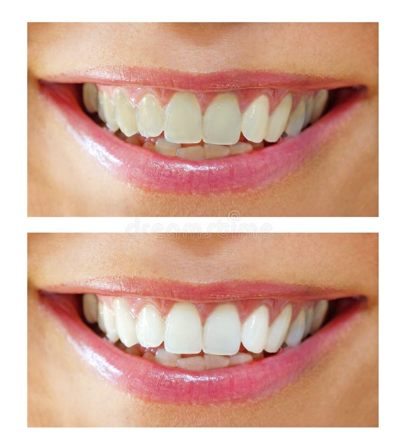 whitening för tand royaltyfria bilder whitening för tand royaltyfria bilder