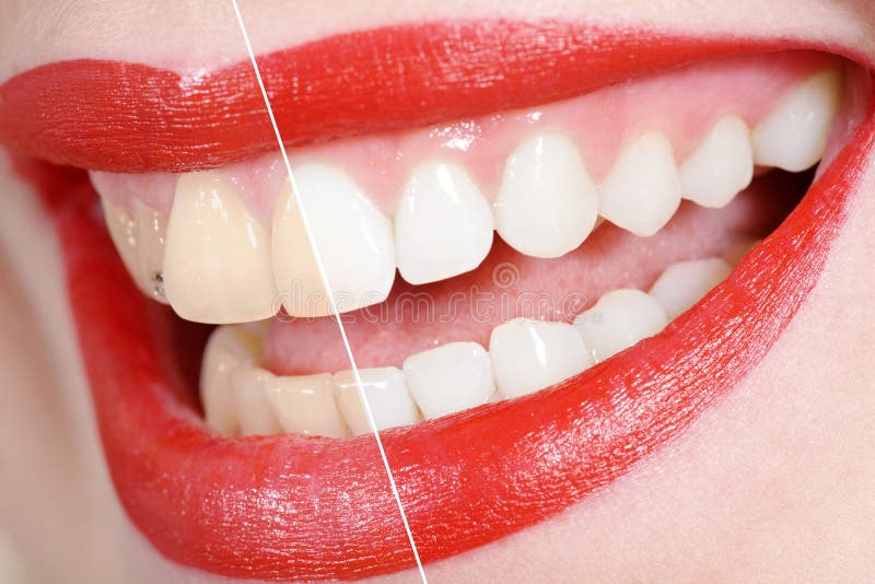 Before and after the tooth whitening. Before and after the tooth whitening