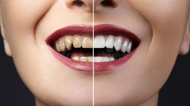 how much are veneers?