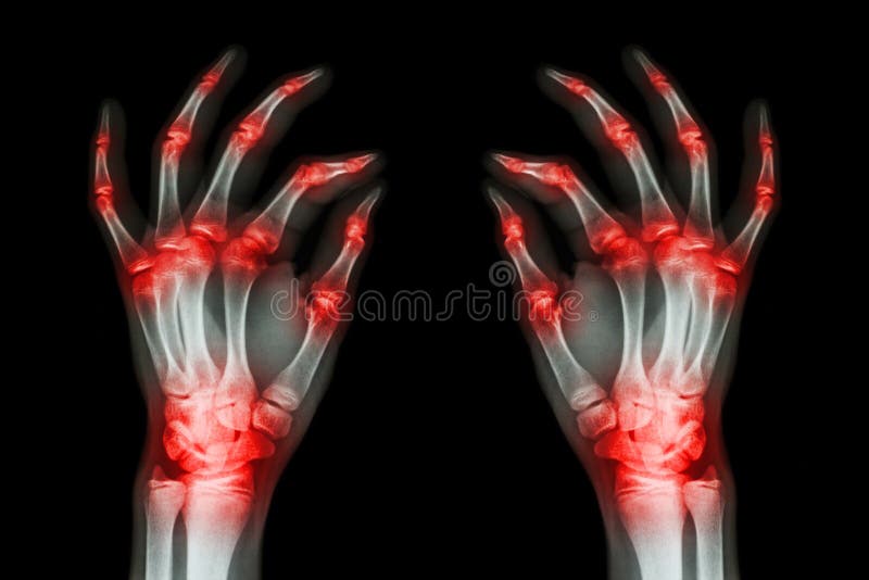 Wielokrotność łączny artretyzm oba dorosłego ręki na czarnym tle (podagra, Rheumatoid) obrazy stock Wielokrotność łączny artretyzm oba dorosłego ręki na czarnym tle (podagra, Rheumatoid) obrazy stock