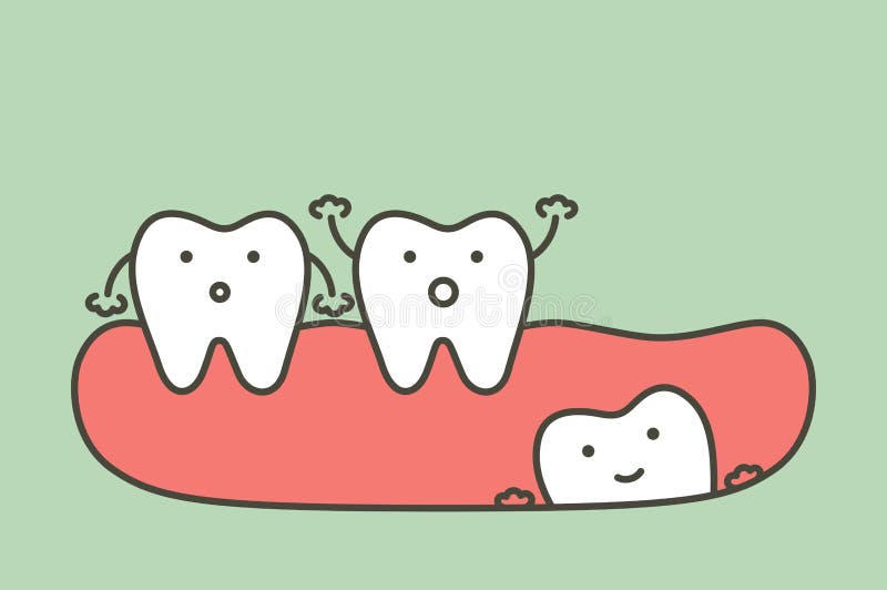 Wisdom tooth angular or mesial impaction affect to other teeth vector illustration Wisdom tooth angular or mesial impaction affect to other teeth vector illustration