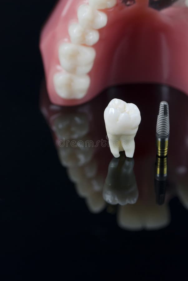 Wisdom Tooth, Implant and Teeth Model Stock Image Image of equipment