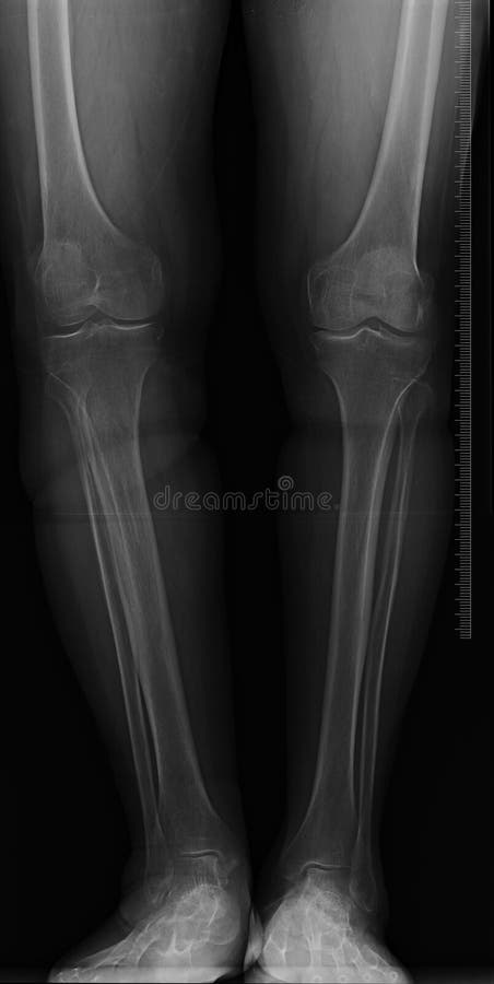 Wizerunku kolana xray fotografia royalty free