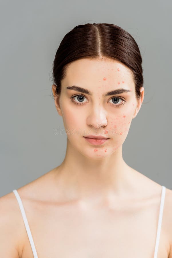 Woman with Acne on Face Looking at Camera Stock Photo Image of pretty