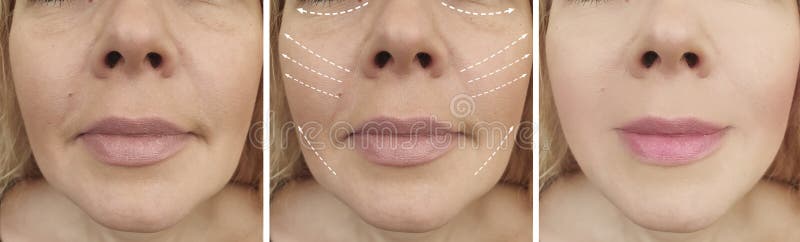 Woman adult wrinkles before after tension  antiaging rejuvenation collage effect cosmetology contrast results