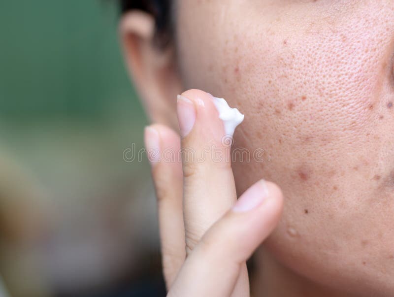 white acne scars on face