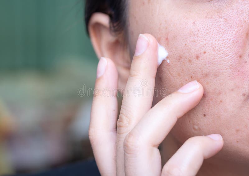 Woman applying cream onto face that has problem problematic skin , acne scars ,oily skin and pore, dark spots and blackhead and whitehead on the face. Problem wrinkle stock images, royalty-free photos and pictures