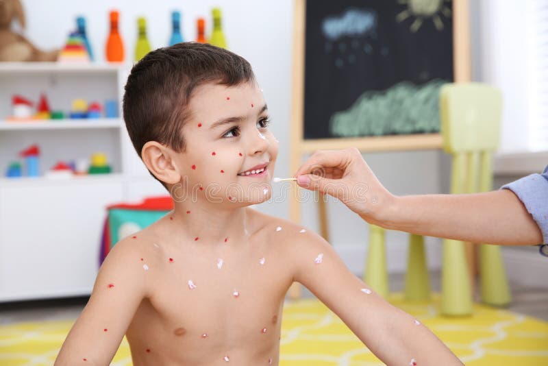 Woman Applying Cream Onto Skin of Boy with Chickenpox at Home Stock
