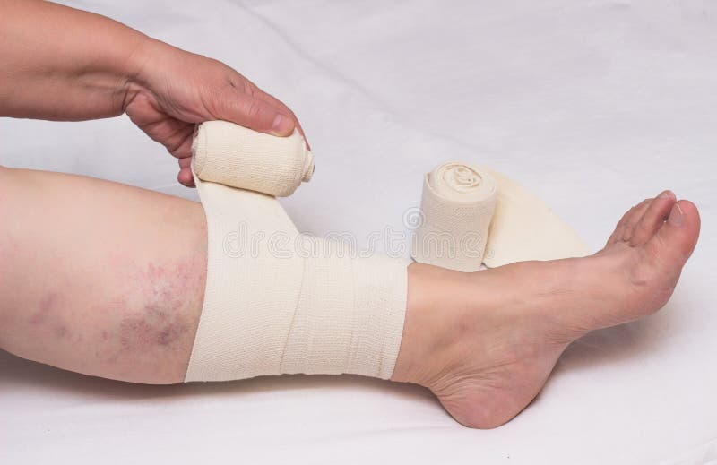 Woman bandages leg with elastic bandage against varicose veins on legs and thrombosis, close-up, white background, phlebeurysm. Medical stock photography
