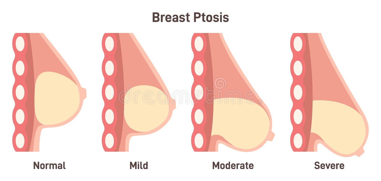 Breast shape (ptosis) as a marker of a woman's breast