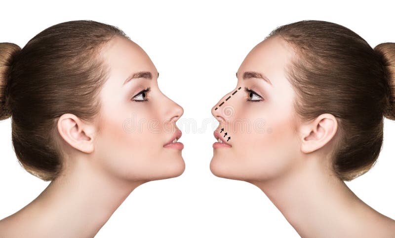 Woman before and after cosmetic nose surgery