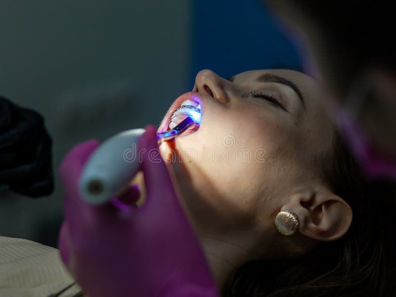 A Woman at a Dentist& X27;s Appointment To Replace Arches with Braces