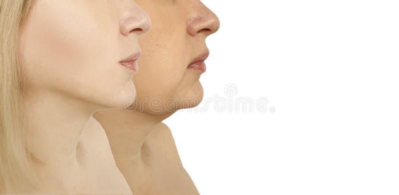 Woman double chin before and after procedures facelift tightening sagging. Problem wrinkle stock images, royalty-free photos and pictures