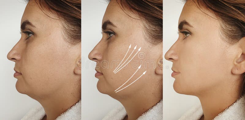 Woman Double Chin Removal Tightening Plastic Saggy Before And After