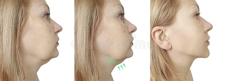 Woman double chin before and after treatment procedure sagging problem. Problem wrinkle stock images, royalty-free photos and pictures