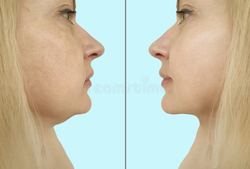 pdo thread lift before and after pdo thread lift before and after