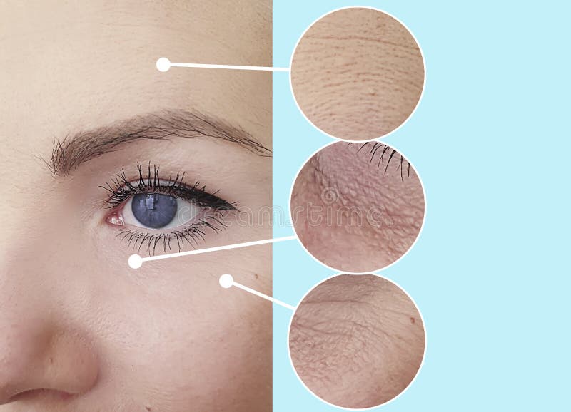 Woman Eye Face Wrinkles Lifting Problem Correction Difference
