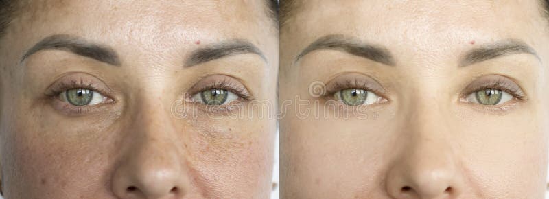 Woman eyes wrinkles before  correction   procedure  removal concept pigmentation difference results treatment revitalization