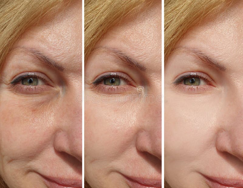 Woman eyes wrinkles antiaging  crease correction contrast revitalization collage treatment before and after treatment effect