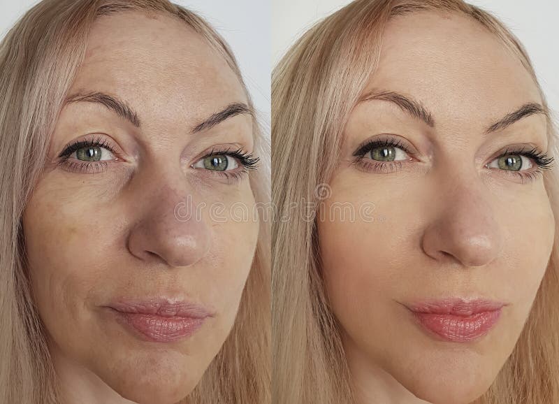 Woman Face Wrinkles Removal Lift Correction Before And After Treatment