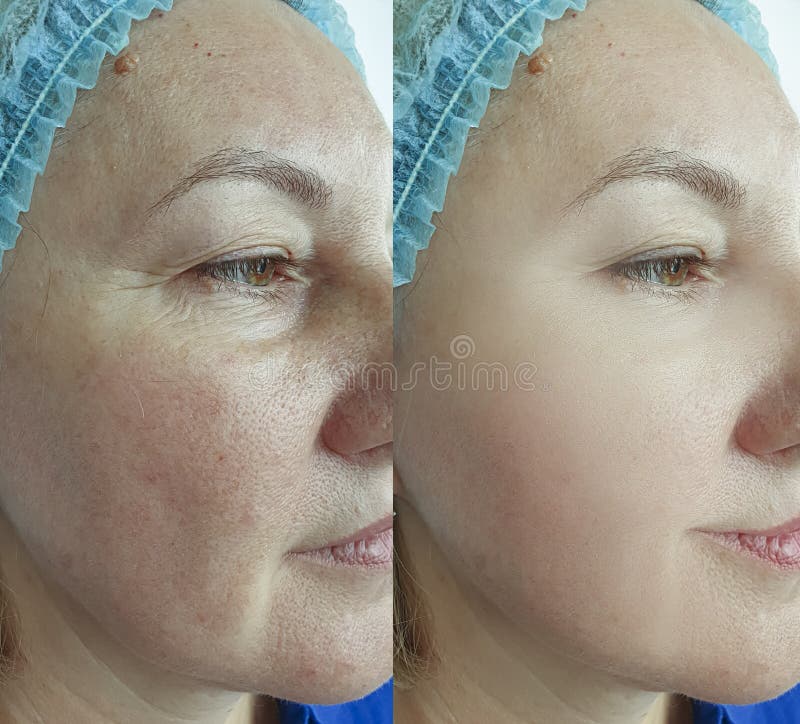 Woman Face Wrinkles before and after Therapy Treatment Stock Photo