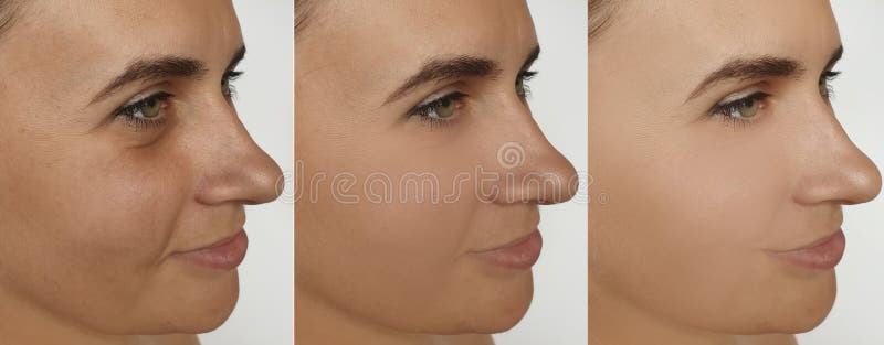 Woman face wrinkles before and after treatment collage antiaging rejuvenation regeneration problem. Problem wrinkle stock images, royalty-free photos and pictures