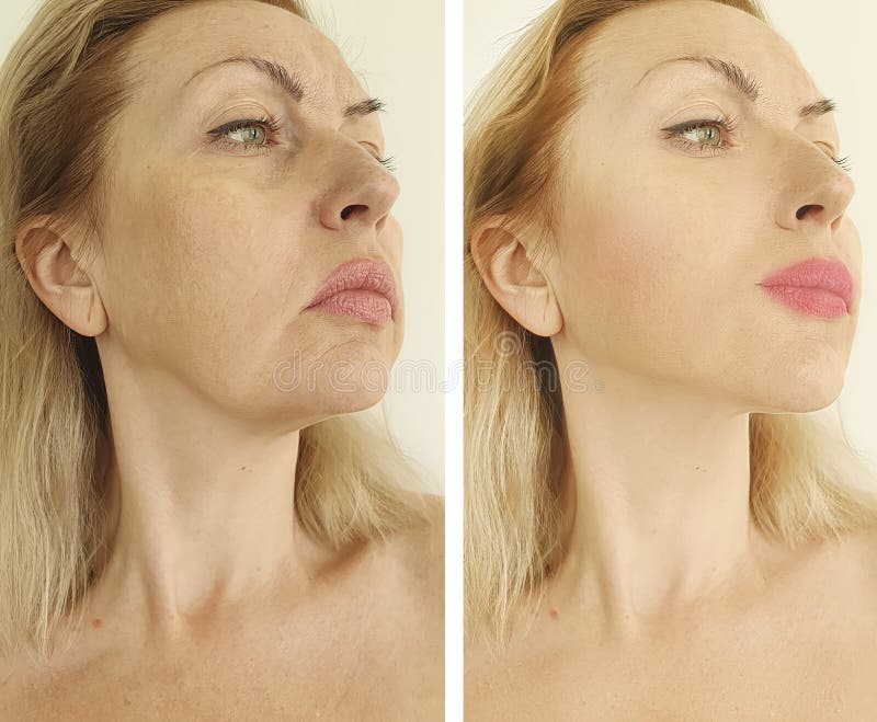 Woman Face Wrinkles Before And After Thread Lifting Treatment Facelift