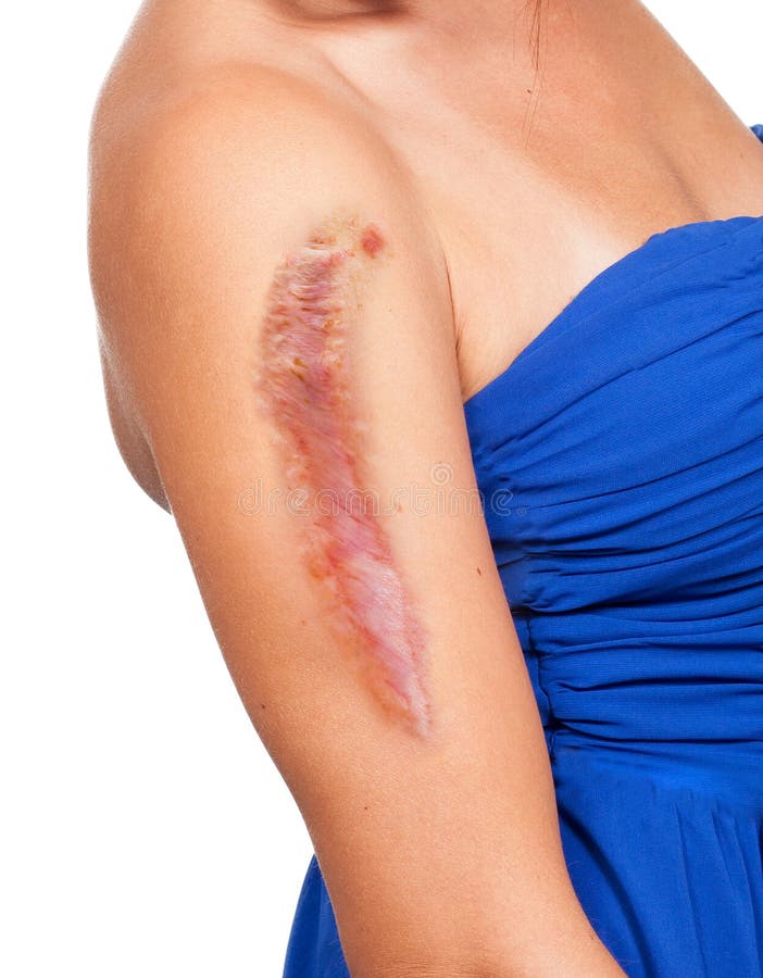 Woman Has a Big Scar on Her Arm Stock Image Image of patient