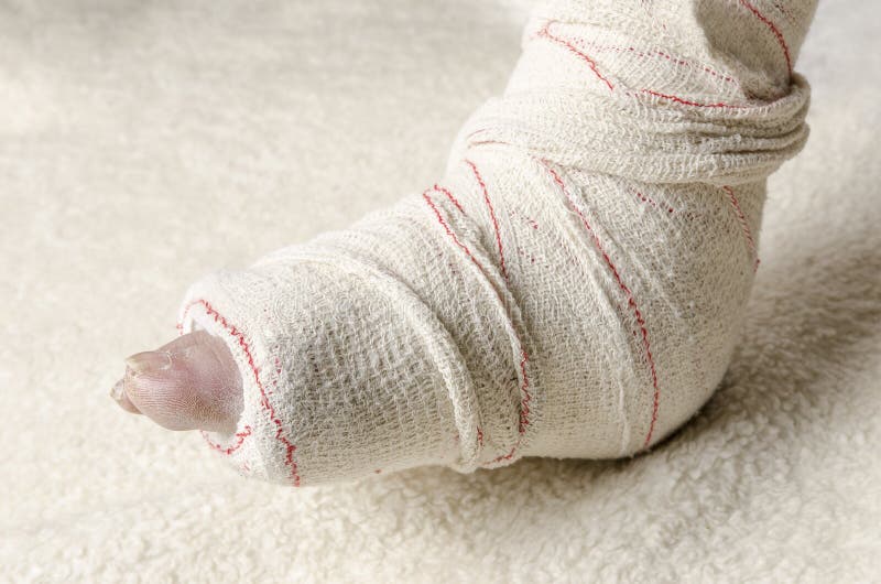 Woman with Her Broken Leg. Arm in a Cast. Stock Image Image of