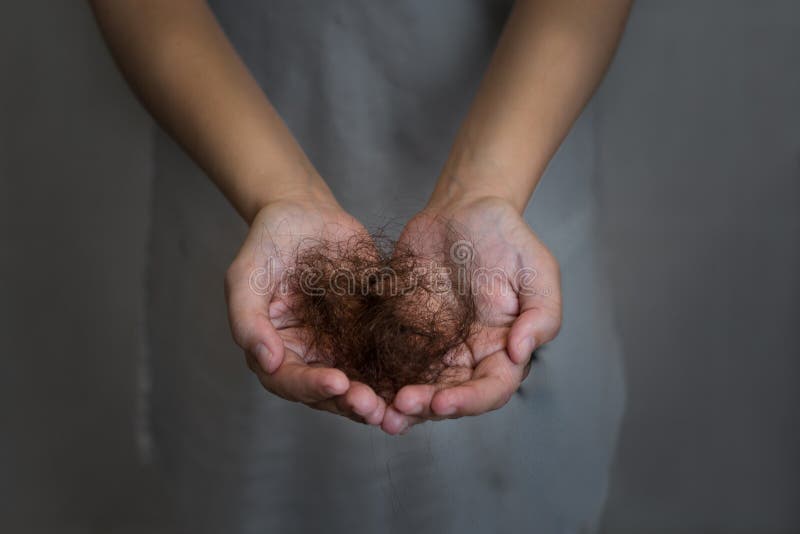 A Woman Suffering from Hair Loss. Balding Stock Photo - Image of cancer,  adult: 149985244