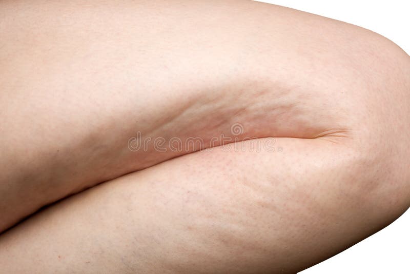 legs and belly of a 40-year-old woman with stretch marks, cellulite and  excess weight on a white isolated background Stock Photo - Alamy