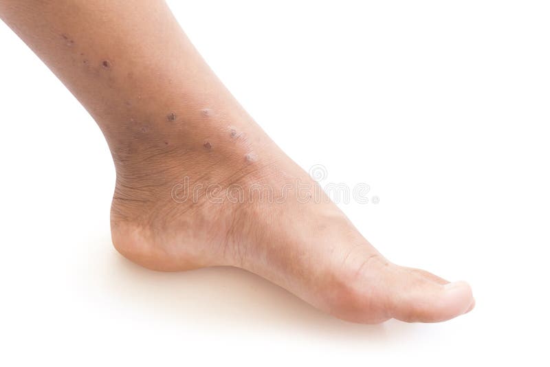 Scars Women's Legs Image & Photo (Free Trial)