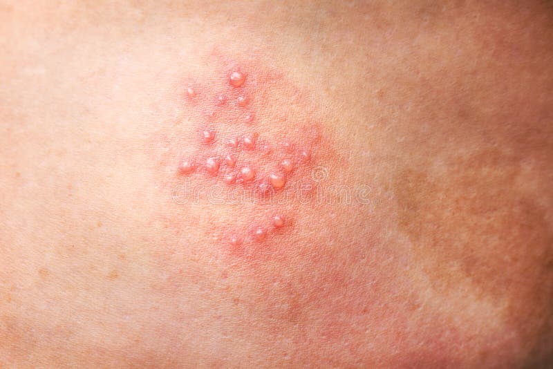 Shingles. Close-up of blisters around the groin of a 76-year-old female  patient with shingles. Shingles is a disease caused by the Herpes zoster  virus Stock Photo - Alamy